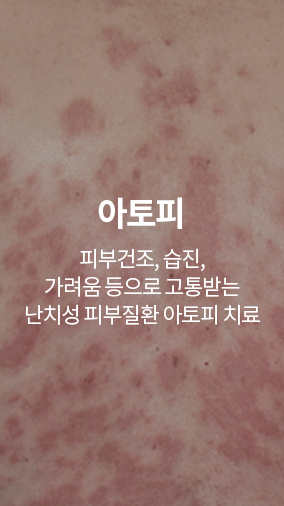 아토피