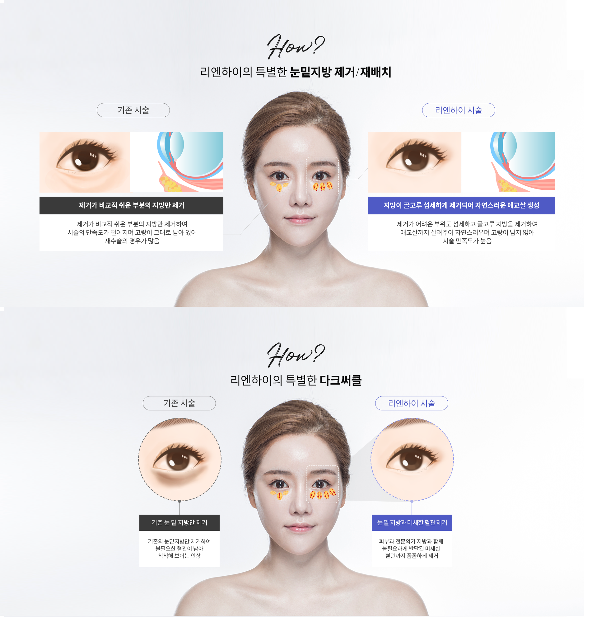 리엔하이의 특별한 눈밑지방제거,다크서클