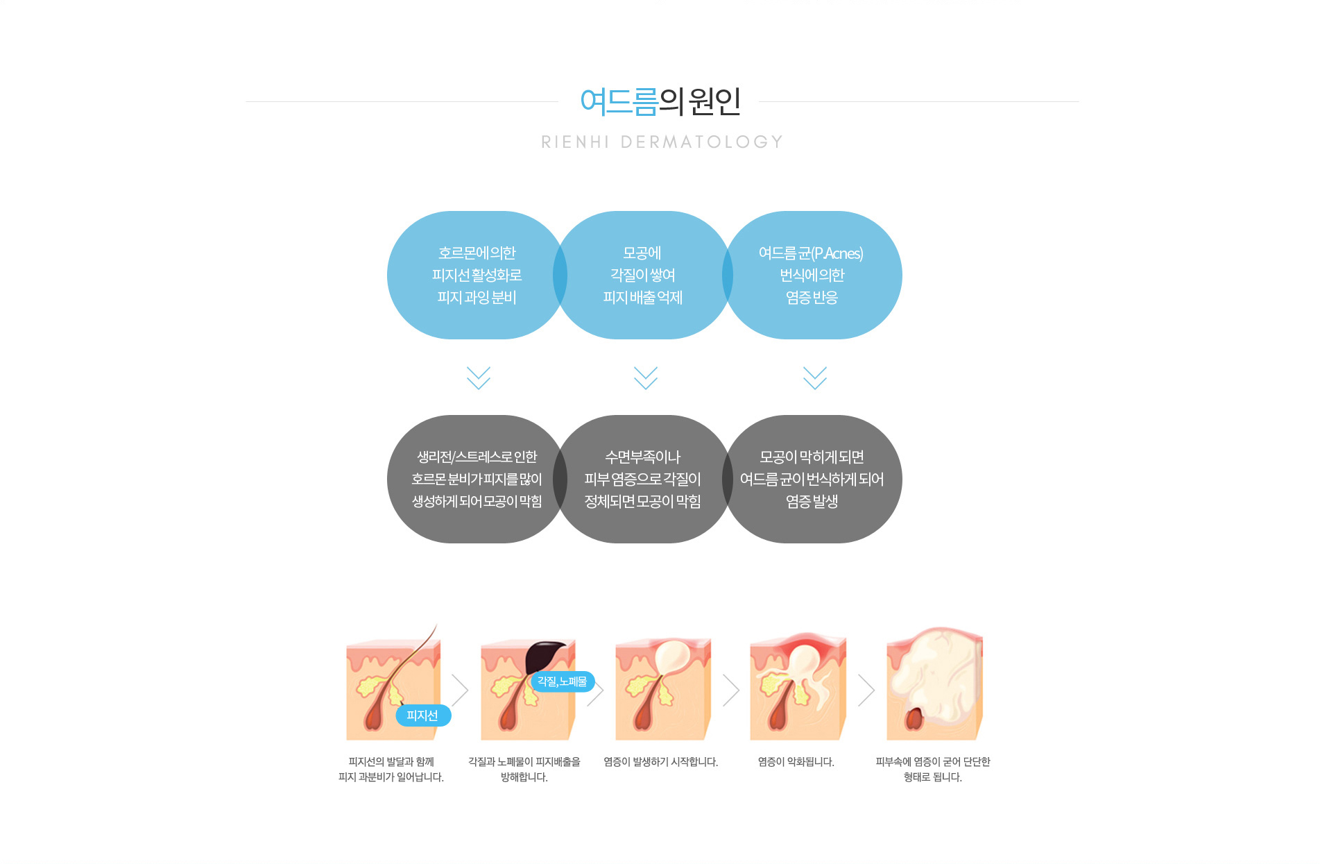 여드름의 원인