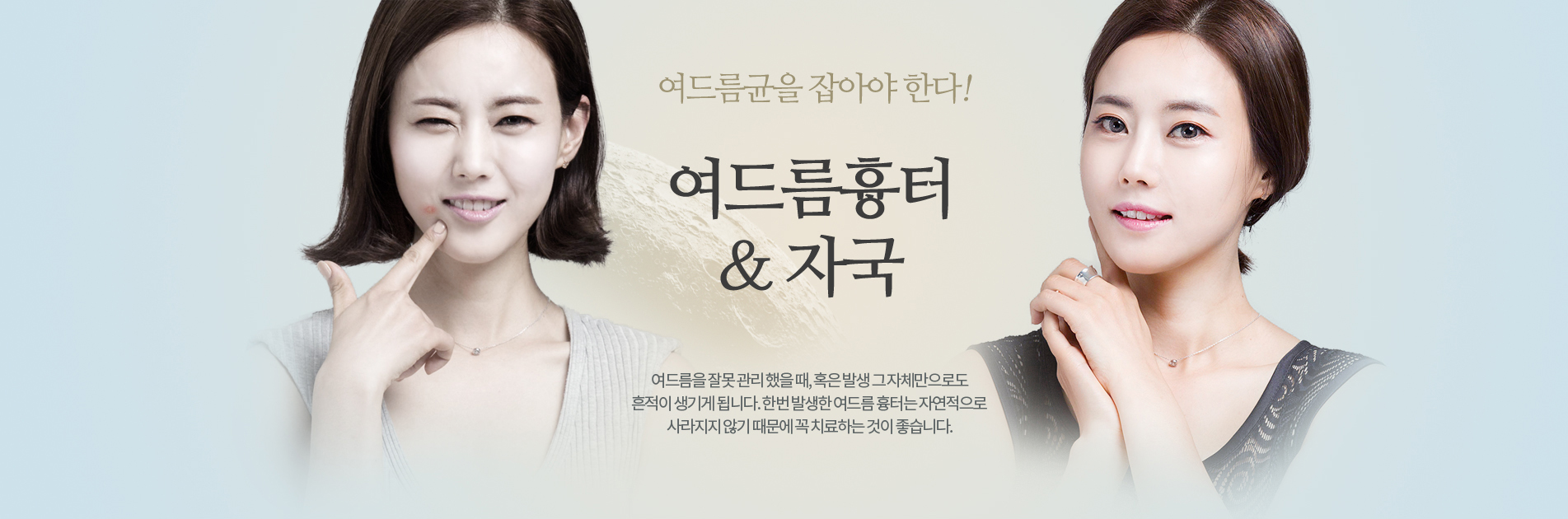 여드름흉터:여드름균을 잡다