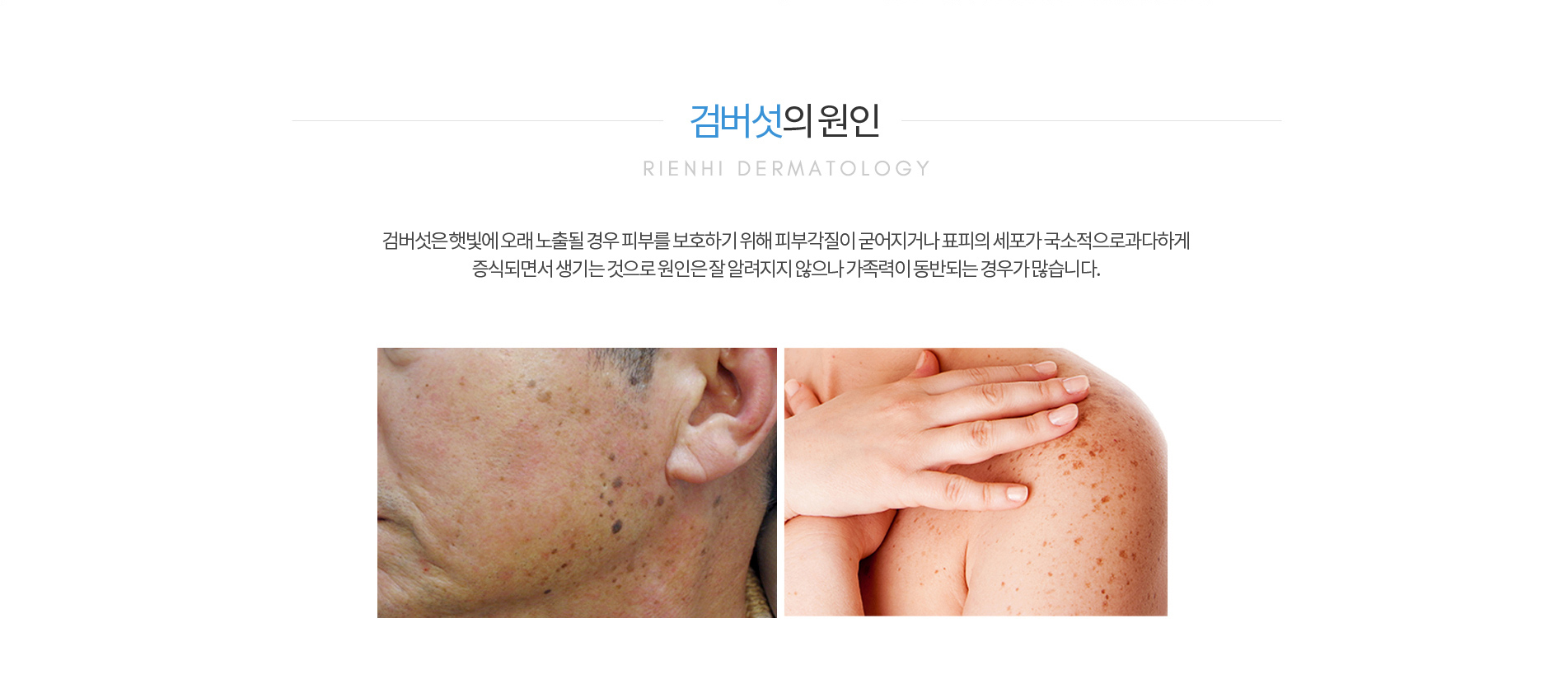 검버섯의 원인