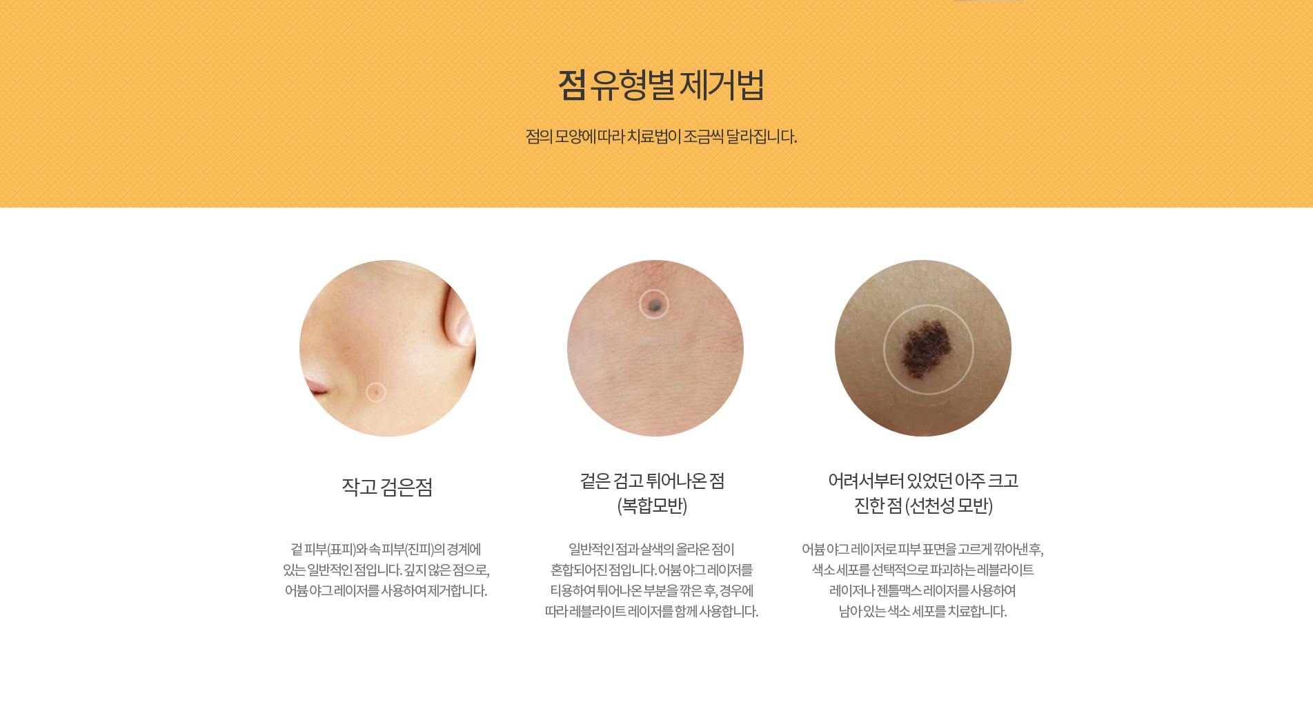 점 유형별 제거법