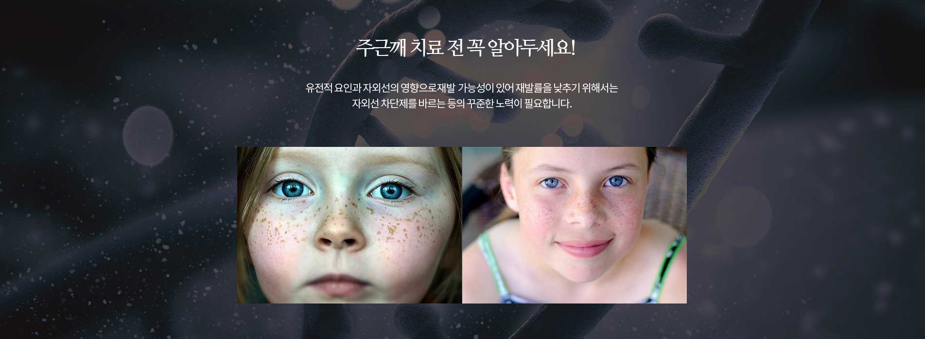 주근깨 치료전 꼭 알아두세요