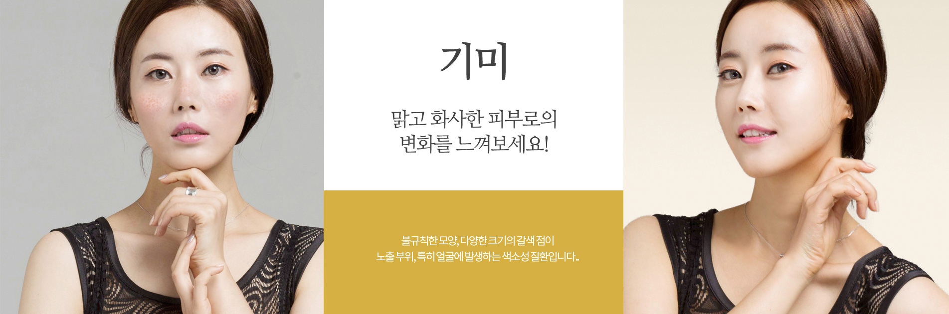 기미:맑고 화사한 피부로 변화를 느껴보세요