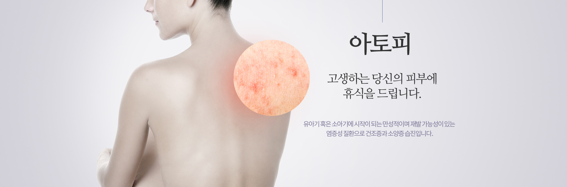 아토피는 만성적이고 재발가능성이 잇는 염증성질환