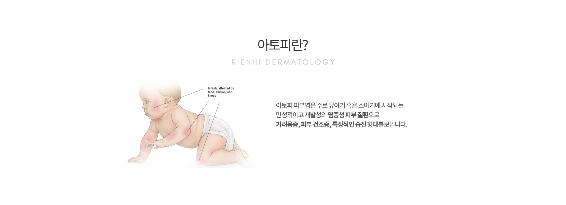 아토피란?