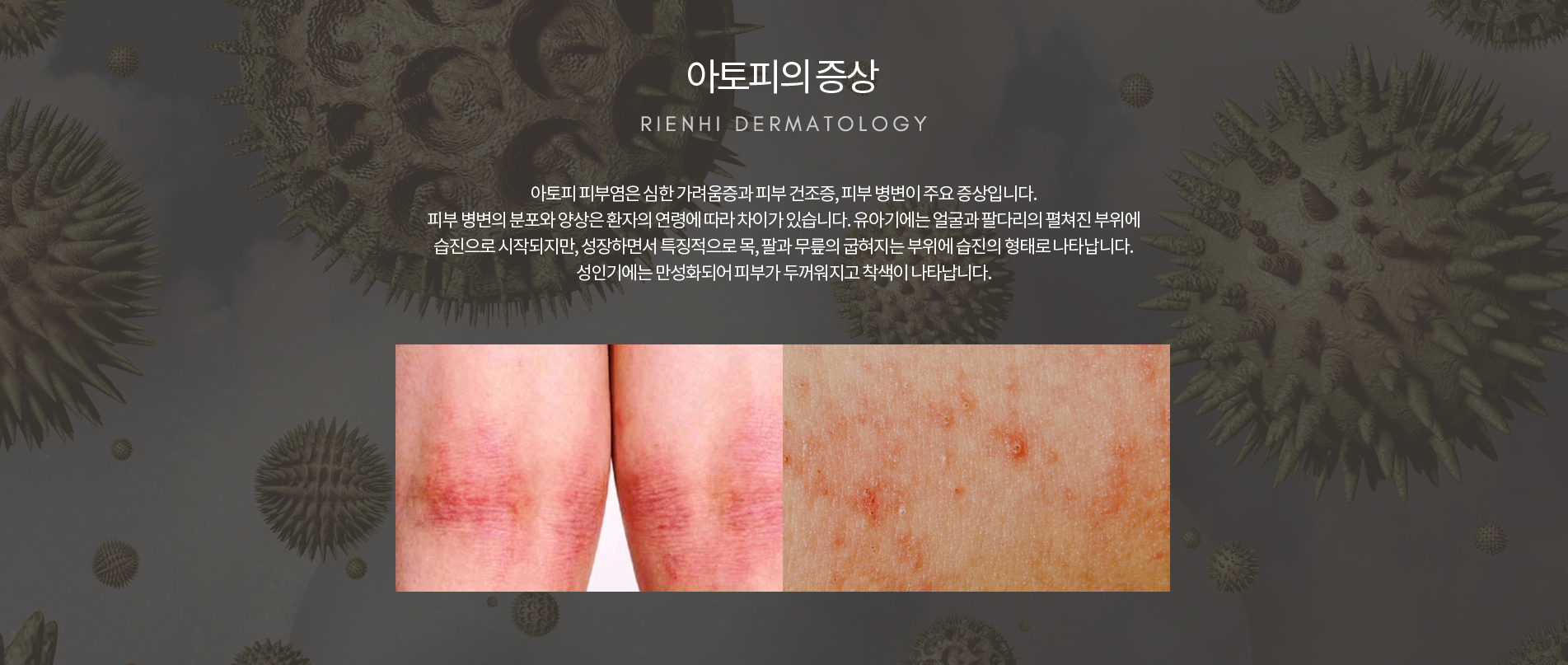 아토피 증상