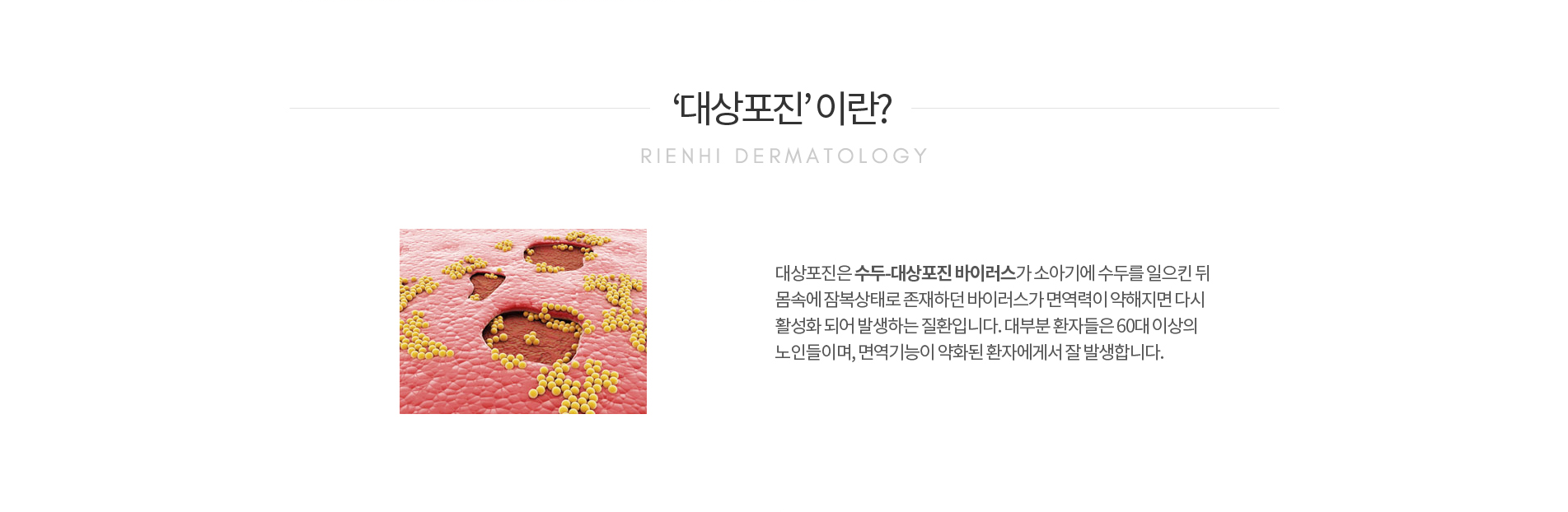 대상포진이란
