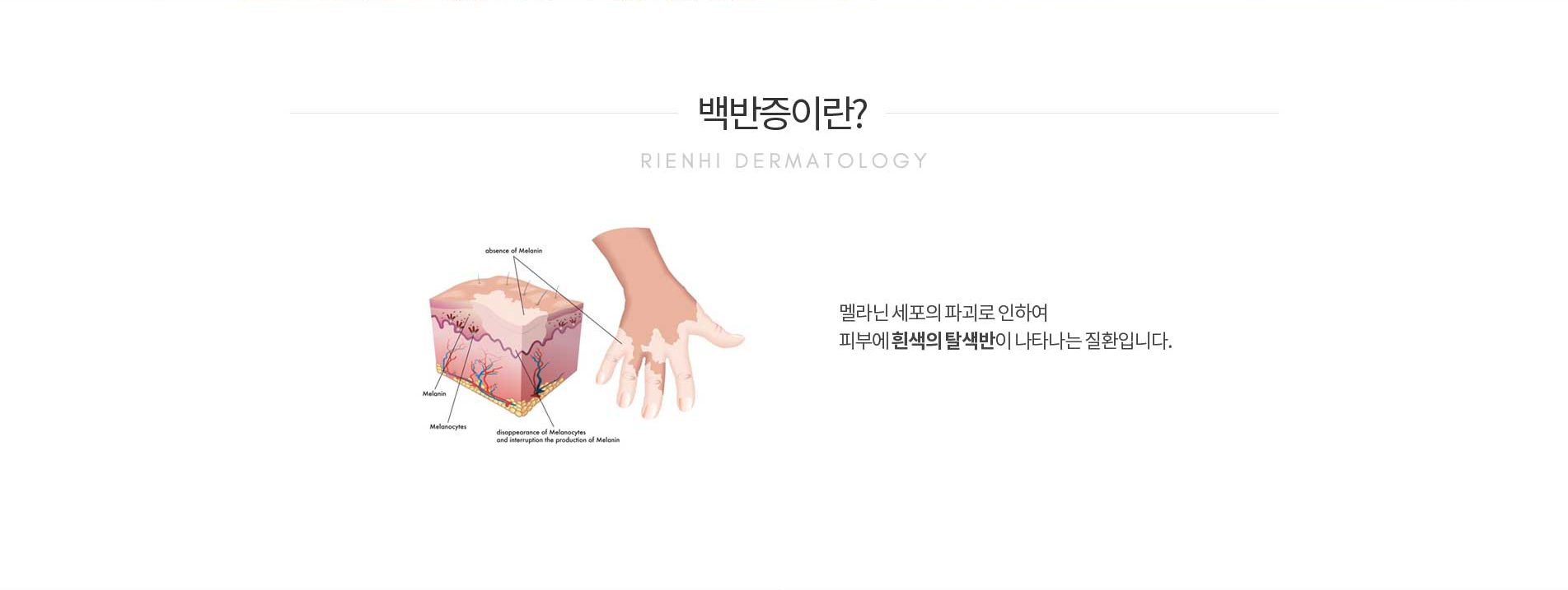 백반증이란?