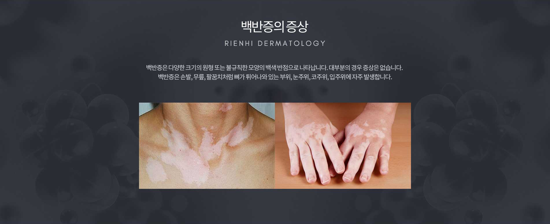 백반증의 증상