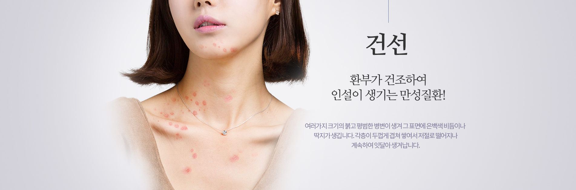 건선 환부가 건조하여 인설이 생기는 만성질환