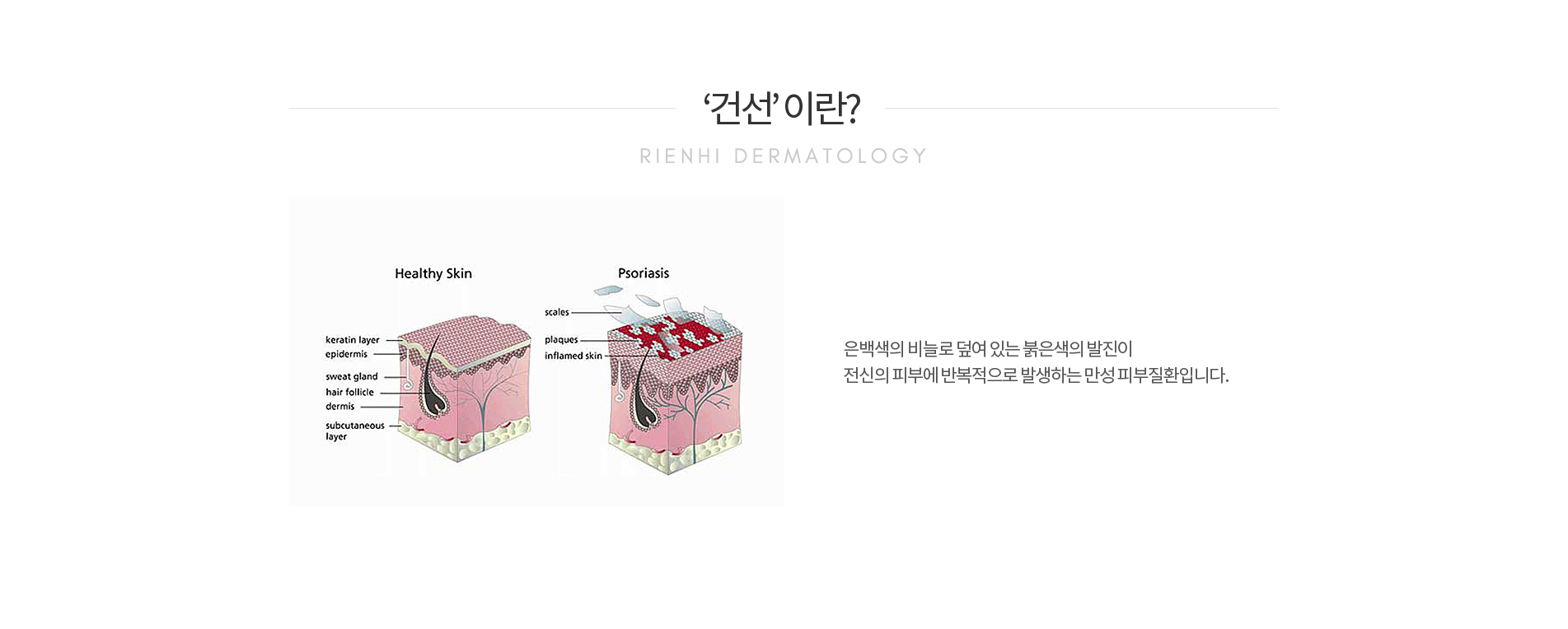 건선이란?