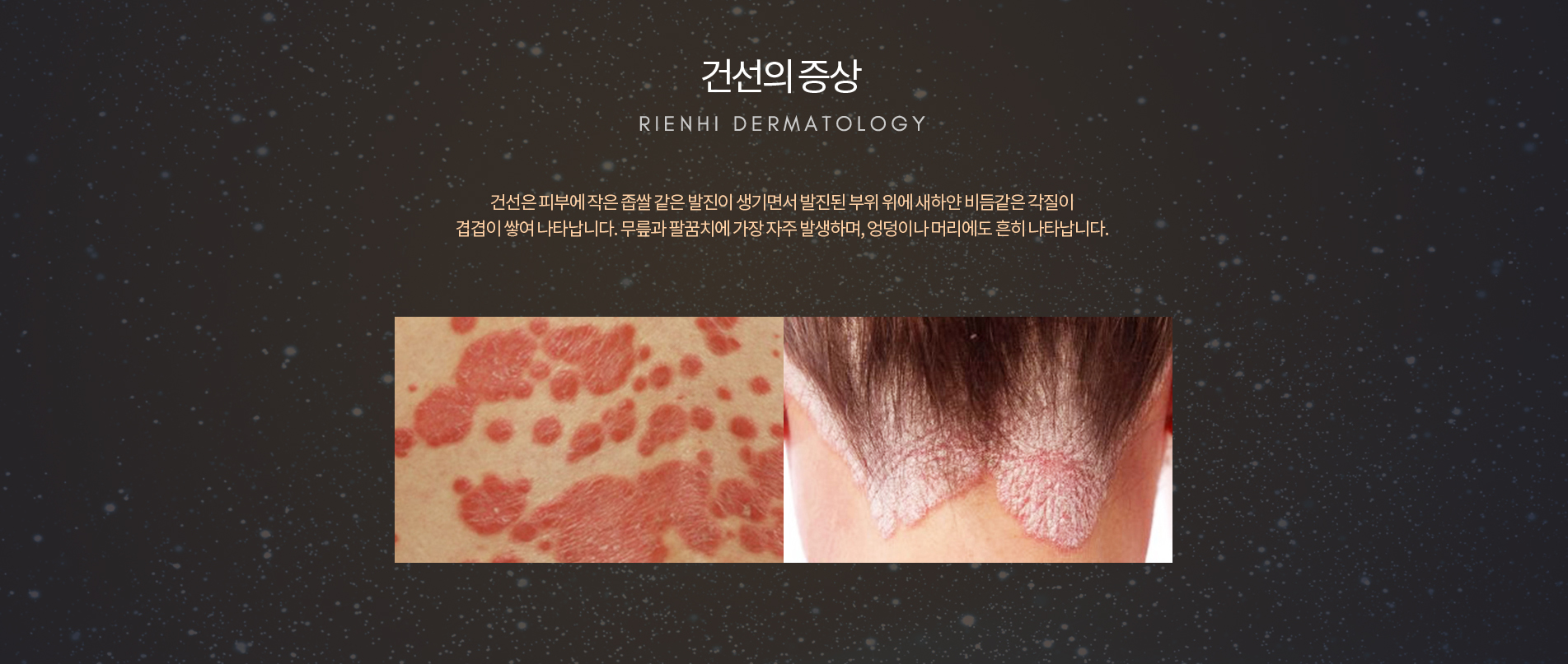 건선 증상