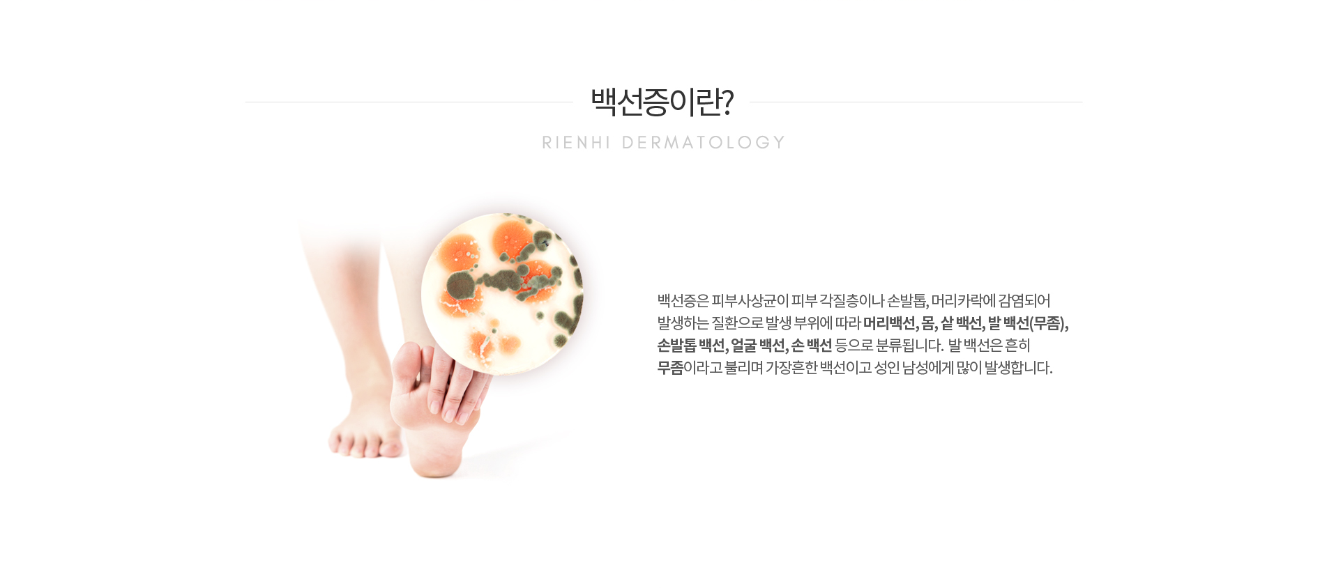 백선증이란