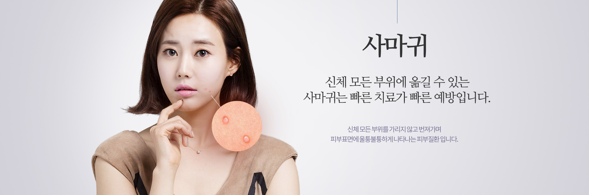 사마귀는 빠른치료가 빠른예방입니다.